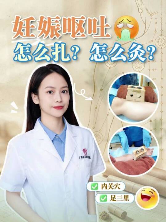 妊娠呕吐怎么扎？怎么灸？